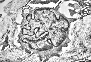 F, 36y. | generalized eruptive histiocytoma - cerebriform nucleus - Sezary cell